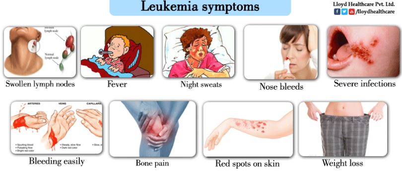 Síntomas de Leucemia 